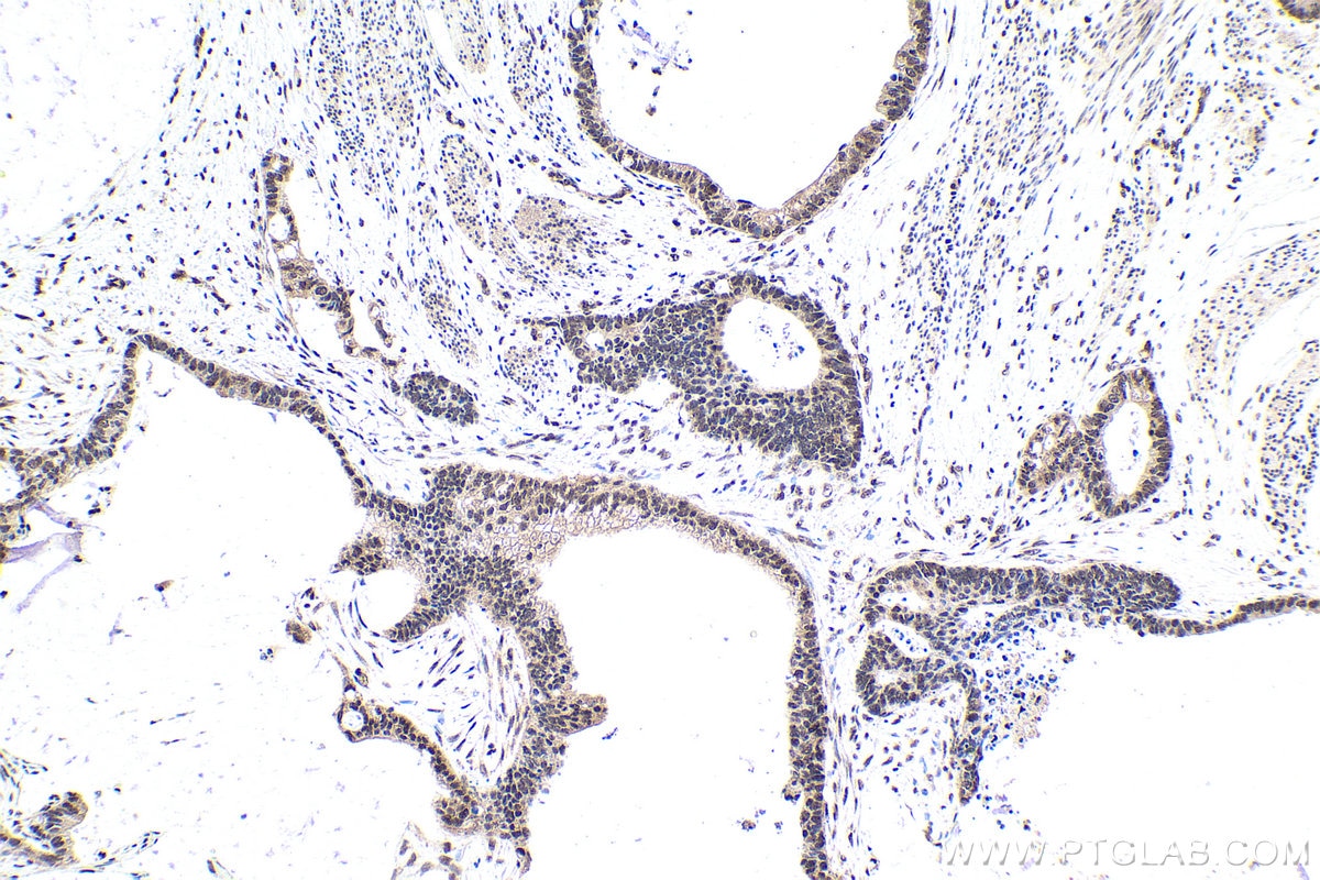 Immunohistochemical analysis of paraffin-embedded human urothelial carcinoma tissue slide using KHC1600 (POLR2I IHC Kit).