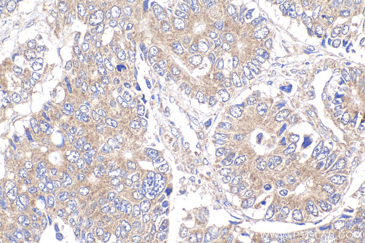 Immunohistochemical analysis of paraffin-embedded human stomach cancer tissue slide using KHC2071 (POLR3G IHC Kit).