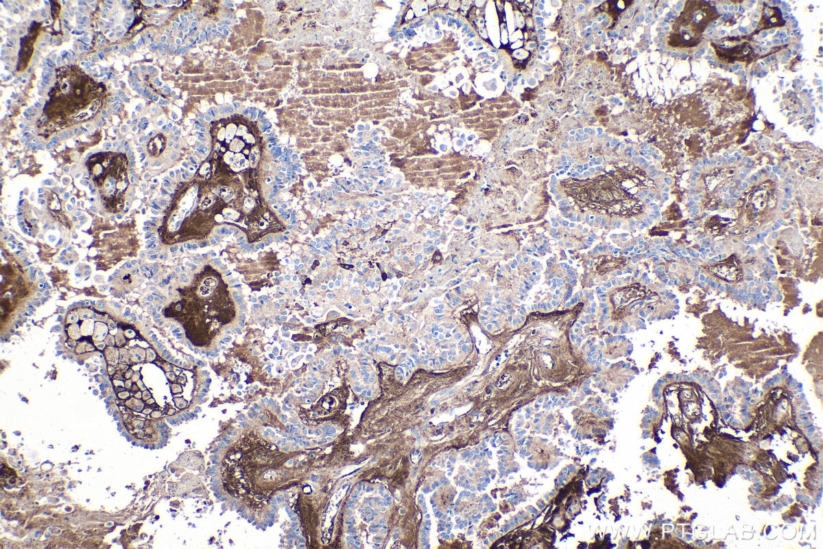 Immunohistochemical analysis of paraffin-embedded human thyroid cancer tissue slide using KHC1371 (PON1 IHC Kit).