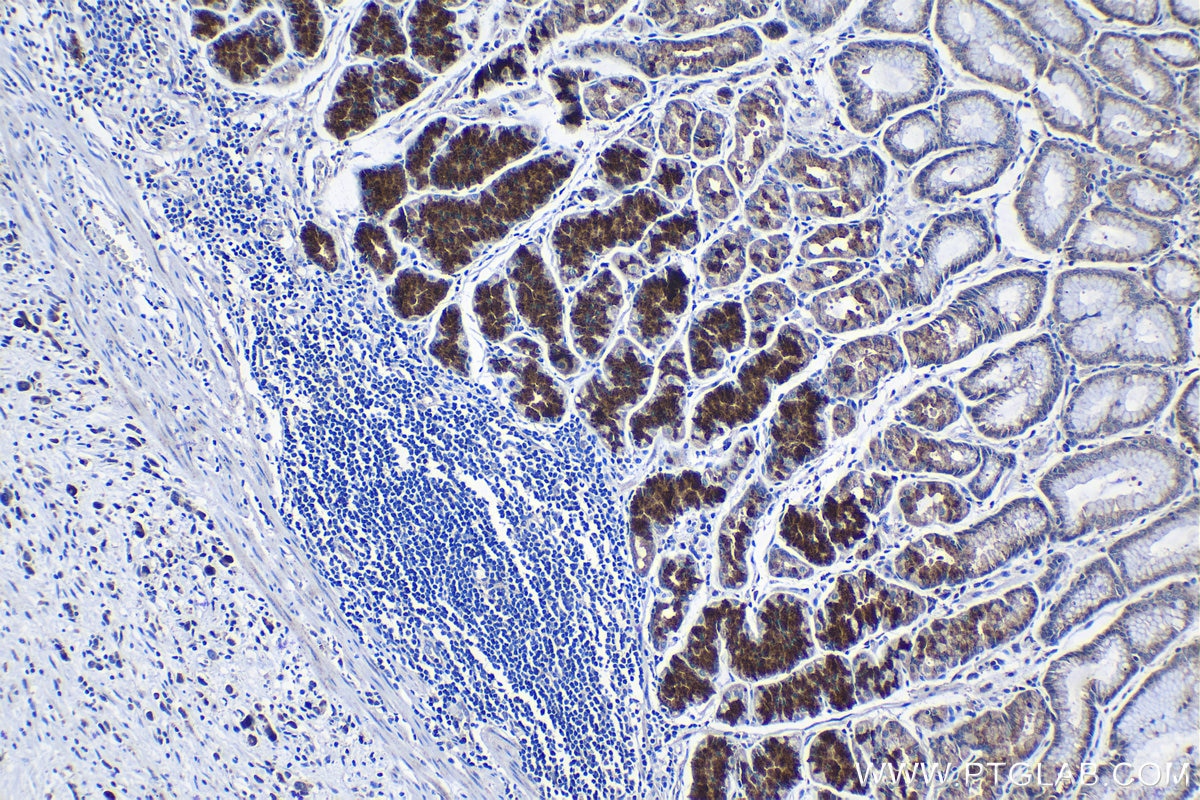 Immunohistochemical analysis of paraffin-embedded human stomach cancer tissue slide using KHC1254 (PON2 IHC Kit).