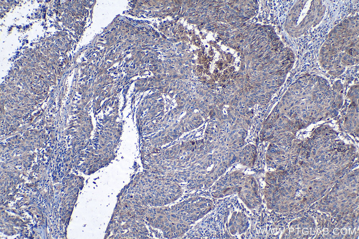 Immunohistochemical analysis of paraffin-embedded human cervical cancer tissue slide using KHC1254 (PON2 IHC Kit).