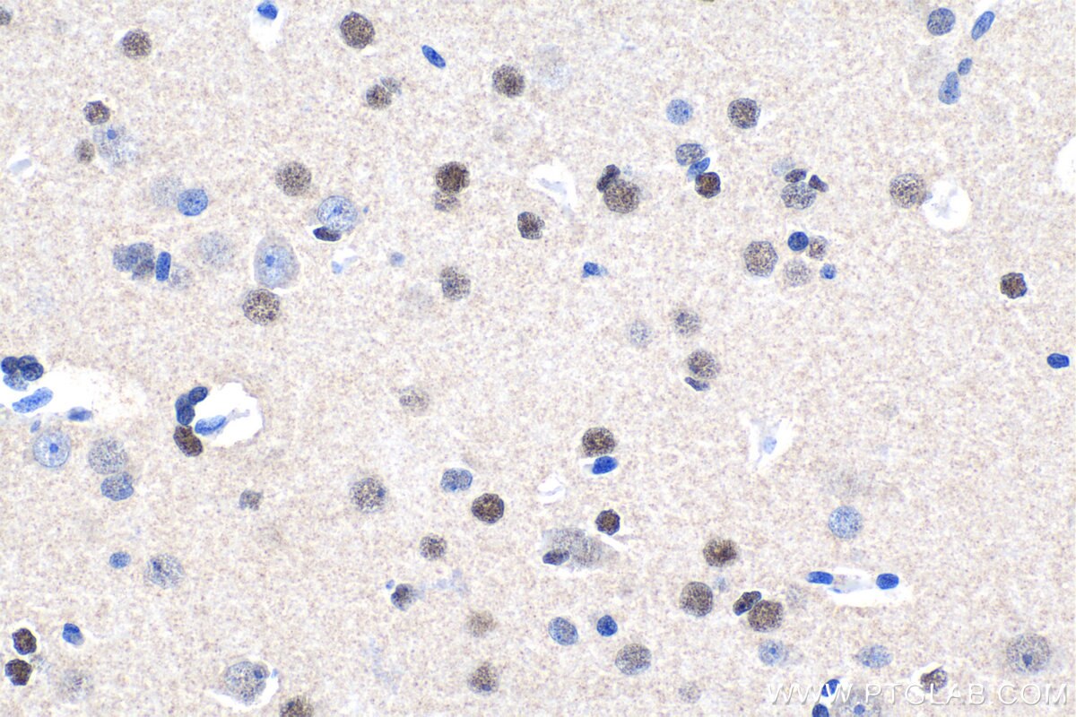 Immunohistochemical analysis of paraffin-embedded human gliomas tissue slide using KHC1549 (POU3F2/BRN2 IHC Kit).