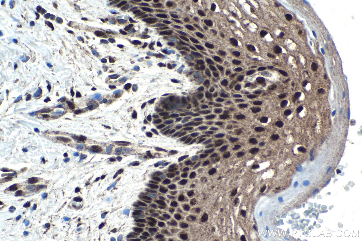 Immunohistochemical analysis of paraffin-embedded human cervical cancer tissue slide using KHC1750 (POU4F3 IHC Kit).