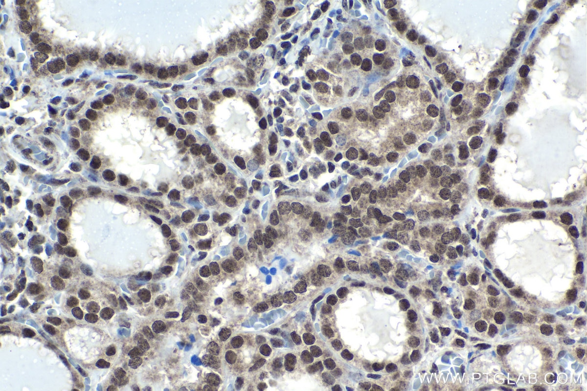 Immunohistochemical analysis of paraffin-embedded human thyroid cancer tissue slide using KHC1750 (POU4F3 IHC Kit).