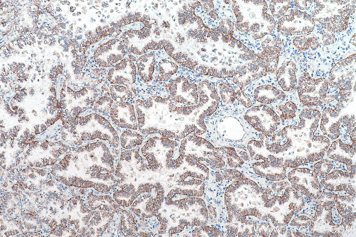 Immunohistochemical analysis of paraffin-embedded human lung cancer tissue slide using KHC0931 (PPA2 IHC Kit).