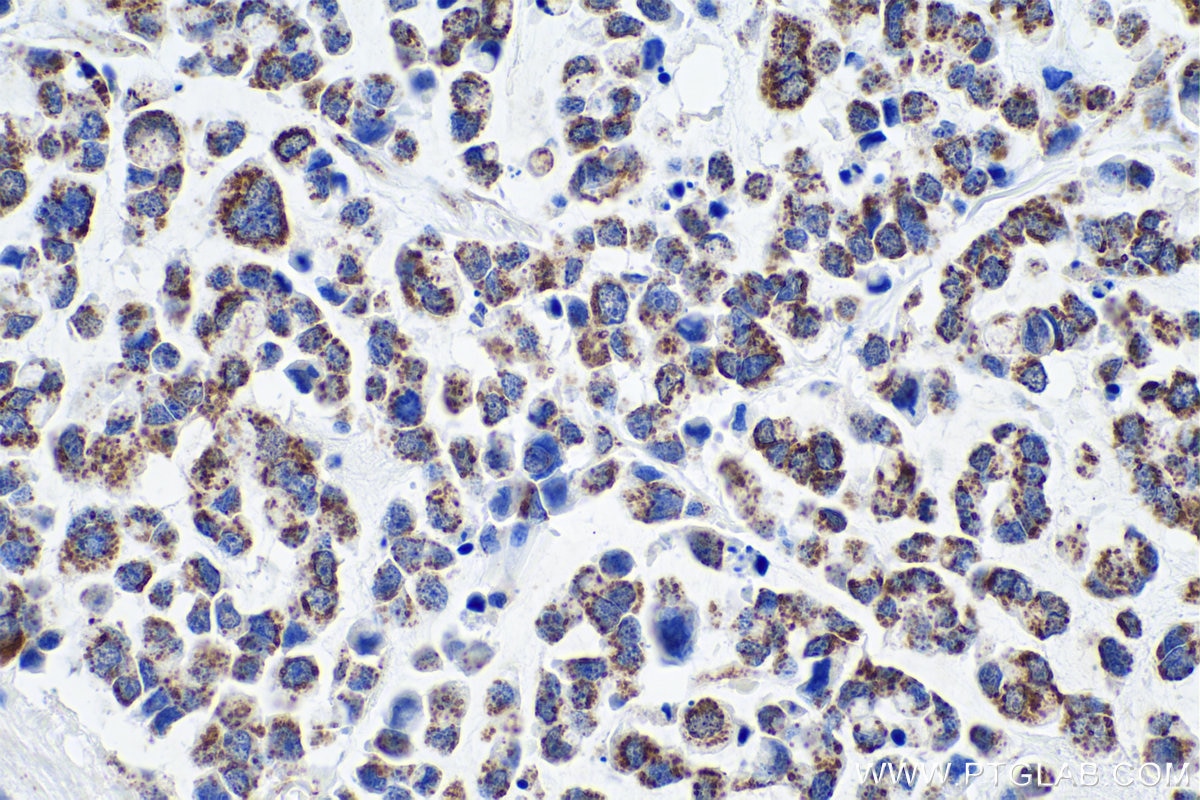 Immunohistochemical analysis of paraffin-embedded human colon cancer tissue slide using KHC0931 (PPA2 IHC Kit).