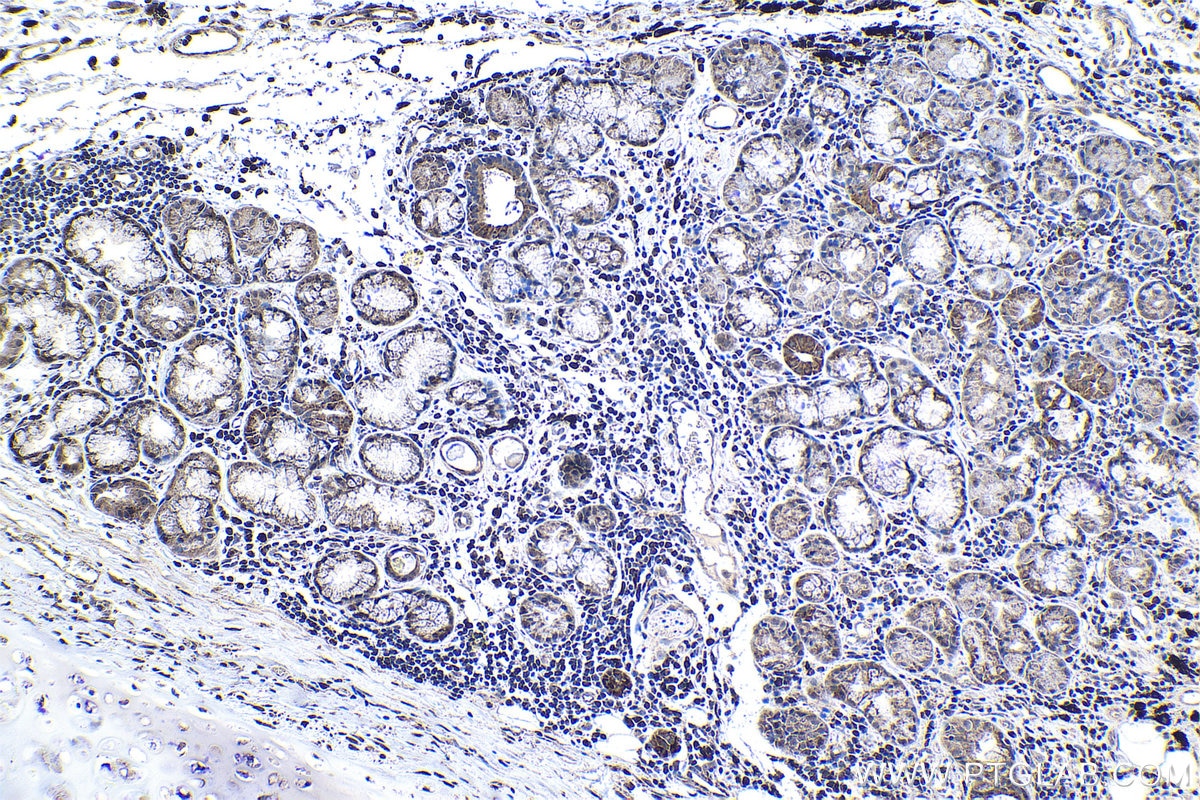 Immunohistochemical analysis of paraffin-embedded human lung cancer tissue slide using KHC1193 (PPAN IHC Kit).