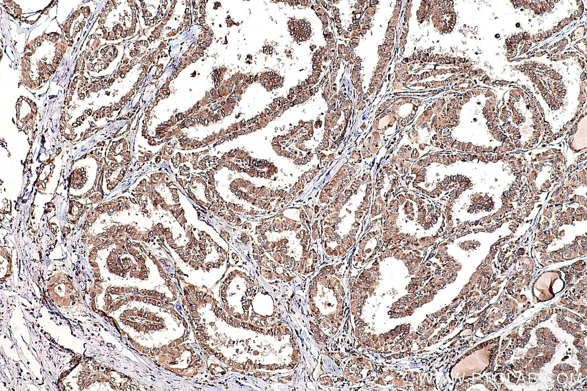 Immunohistochemical analysis of paraffin-embedded human thyroid cancer tissue slide using KHC0249 (PPARG IHC Kit).