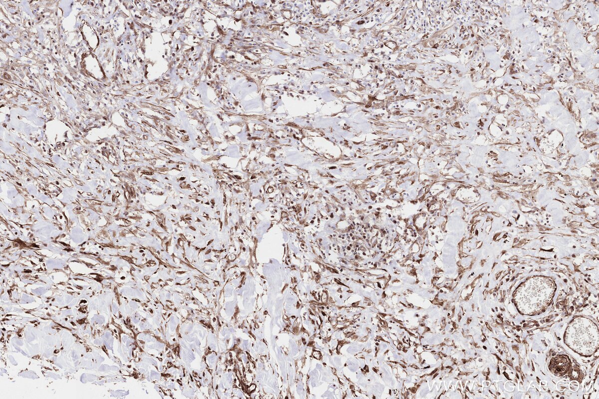 Immunohistochemical analysis of paraffin-embedded human colon cancer tissue slide using KHC3247 (PPAT IHC Kit).