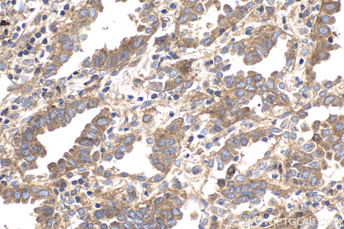 Immunohistochemical analysis of paraffin-embedded human lung cancer tissue slide using KHC1703 (PPFIA1 IHC Kit).