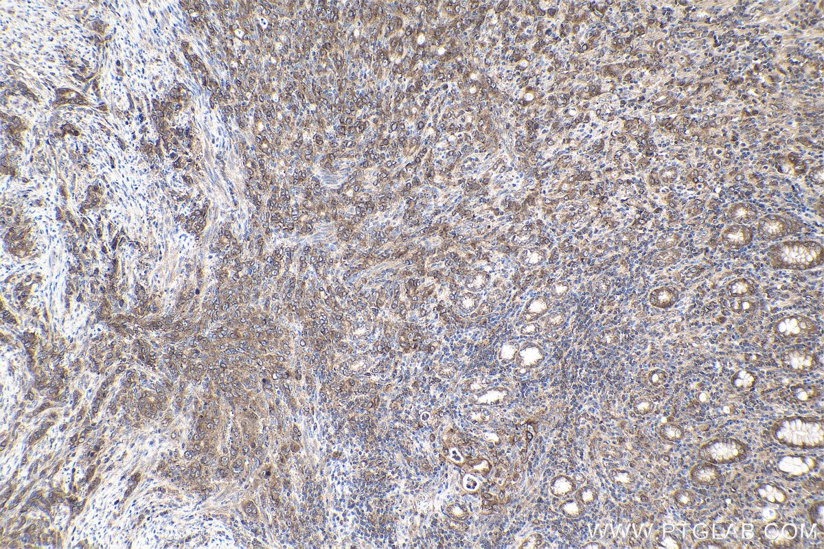 Immunohistochemical analysis of paraffin-embedded human stomach cancer tissue slide using KHC1703 (PPFIA1 IHC Kit).