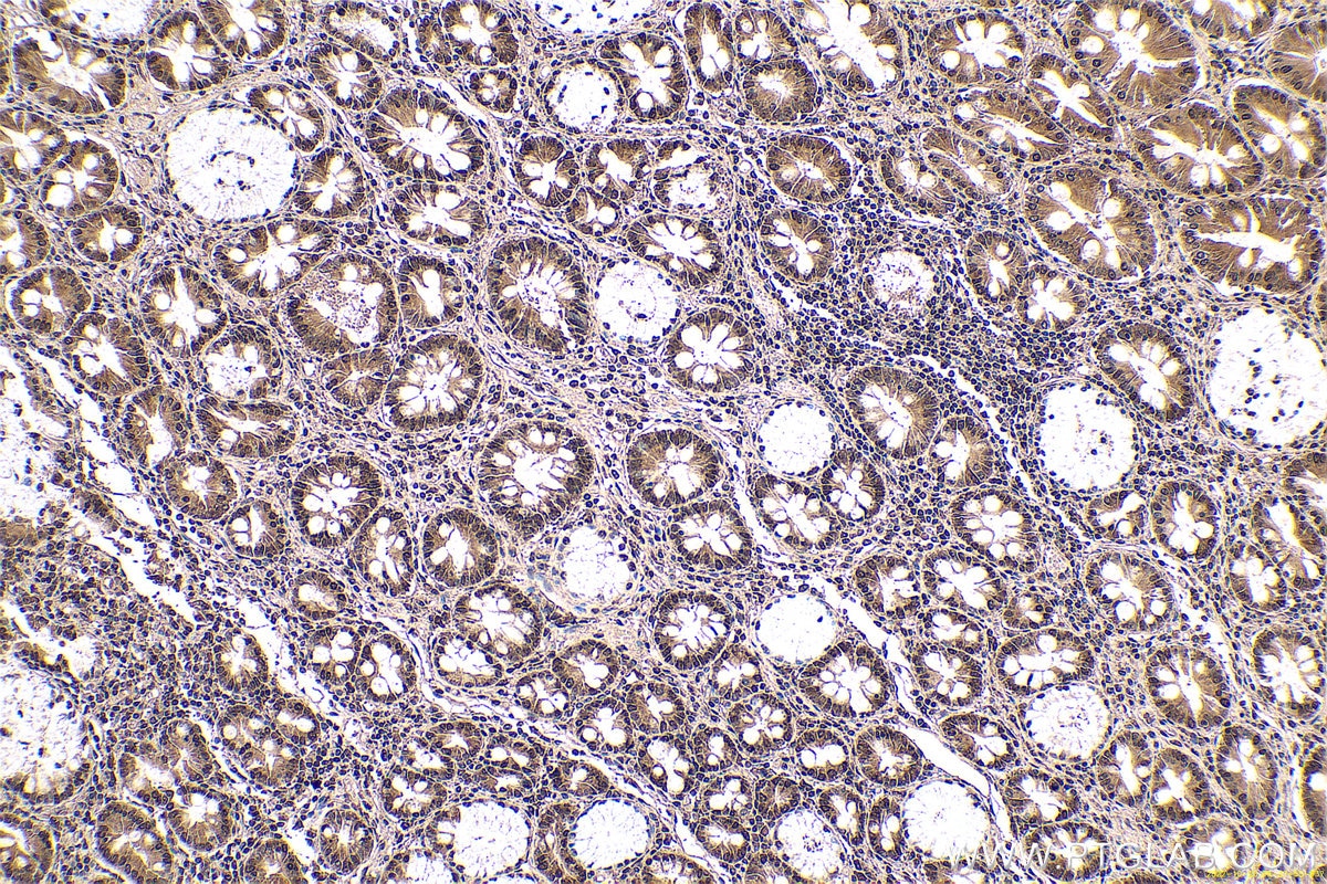 Immunohistochemical analysis of paraffin-embedded human stomach cancer tissue slide using KHC0654 (PPIA IHC Kit).
