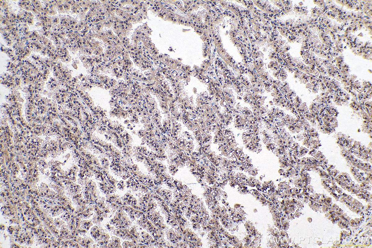 Immunohistochemical analysis of paraffin-embedded human lung cancer tissue slide using KHC0654 (PPIA IHC Kit).