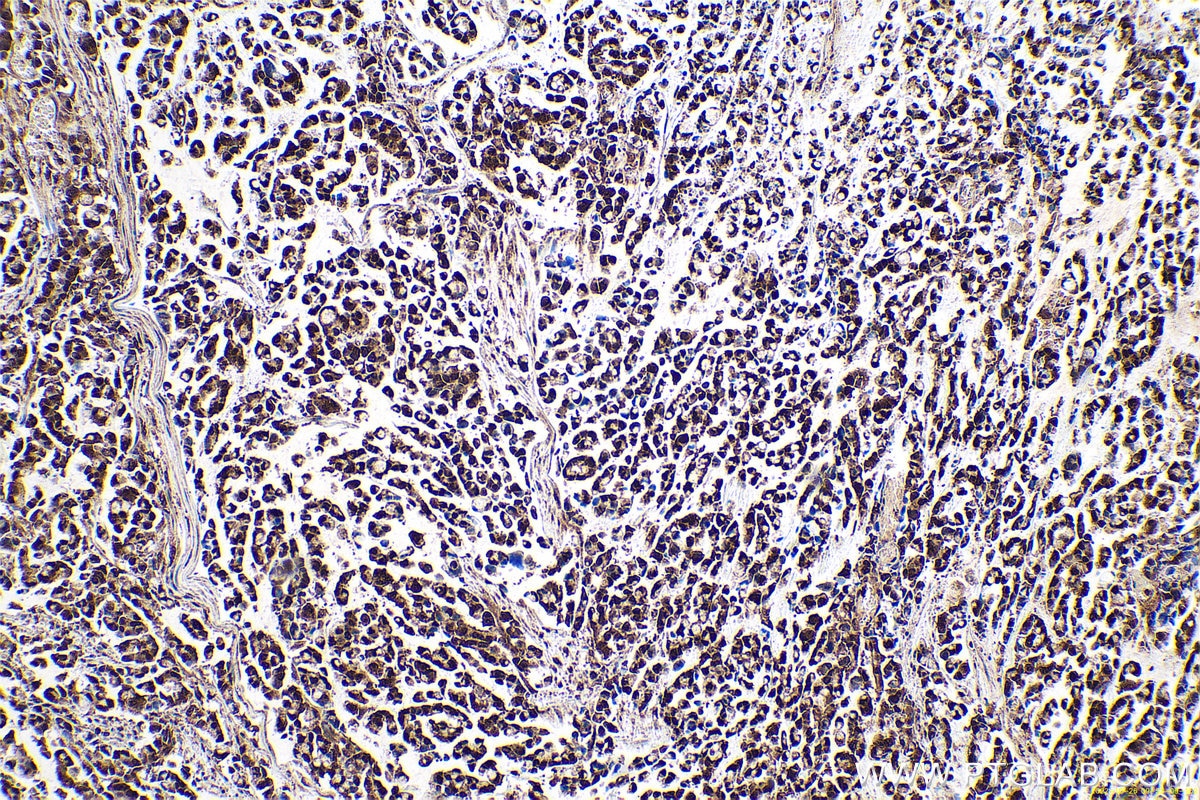 Immunohistochemical analysis of paraffin-embedded human colon cancer tissue slide using KHC0654 (PPIA IHC Kit).