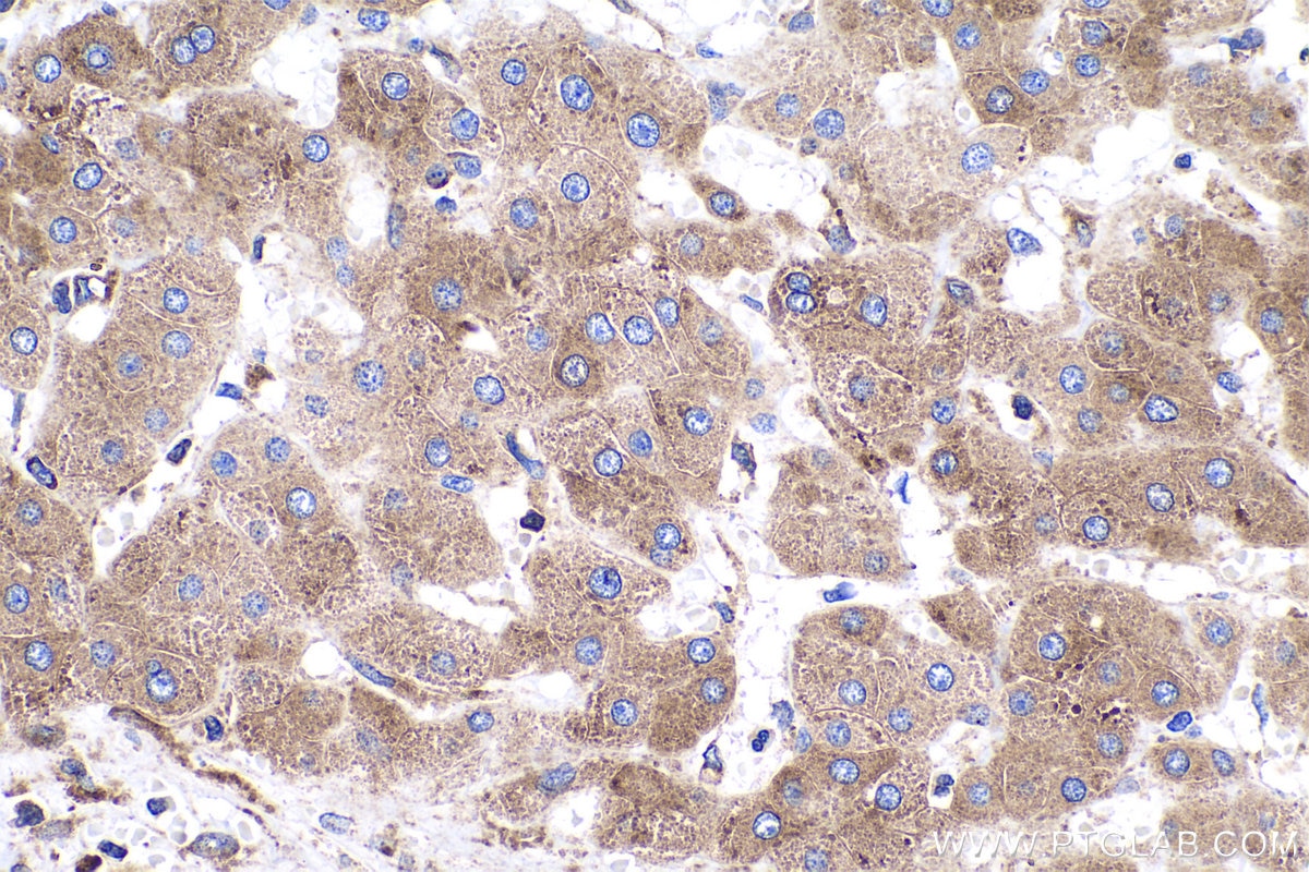 Immunohistochemical analysis of paraffin-embedded human liver cancer tissue slide using KHC0523 (PPIB IHC Kit).