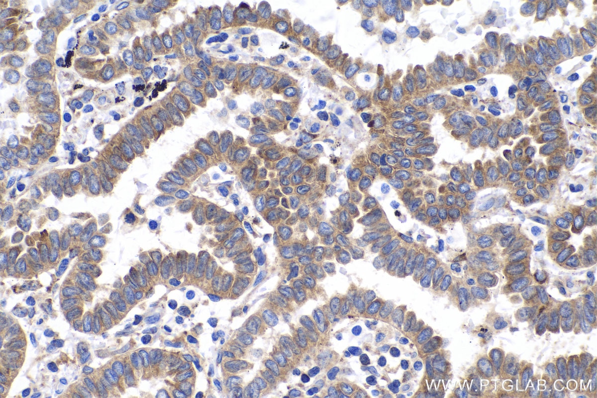 Immunohistochemical analysis of paraffin-embedded human lung cancer tissue slide using KHC0523 (PPIB IHC Kit).