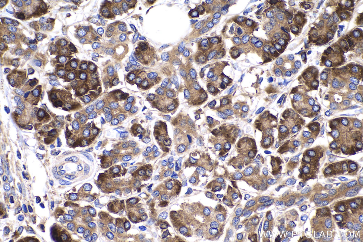 Immunohistochemical analysis of paraffin-embedded human pancreas cancer tissue slide using KHC0523 (PPIB IHC Kit).