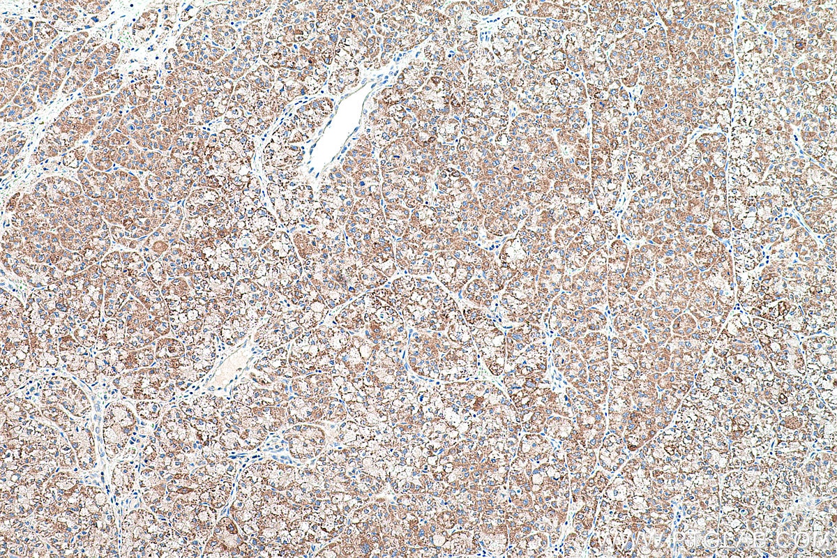 Immunohistochemical analysis of paraffin-embedded human liver cancer tissue slide using KHC0447 (PPIF IHC Kit).
