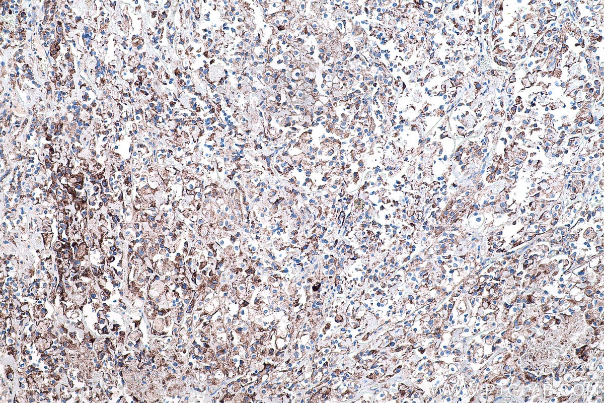 Immunohistochemical analysis of paraffin-embedded human endometrial cancer tissue slide using KHC0447 (PPIF IHC Kit).