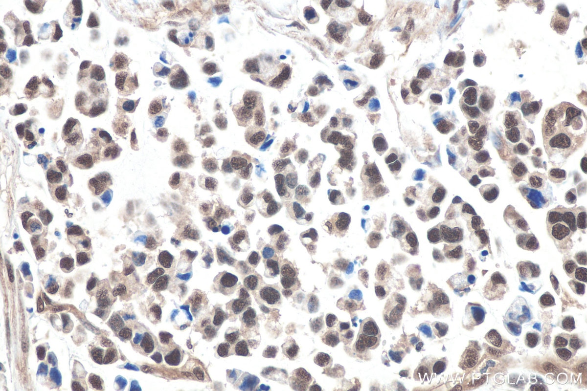 Immunohistochemical analysis of paraffin-embedded human colon cancer tissue slide using KHC0836 (PPIL1 IHC Kit).