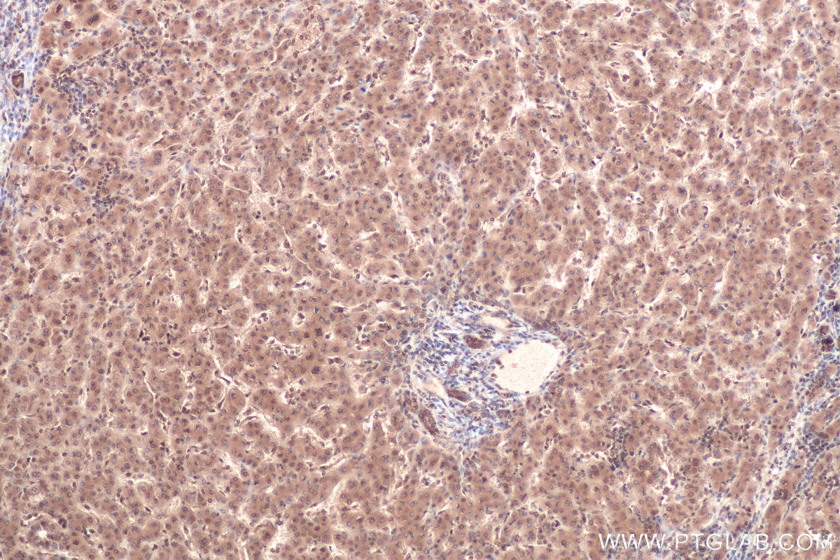 Immunohistochemical analysis of paraffin-embedded human liver cancer tissue slide using KHC0836 (PPIL1 IHC Kit).