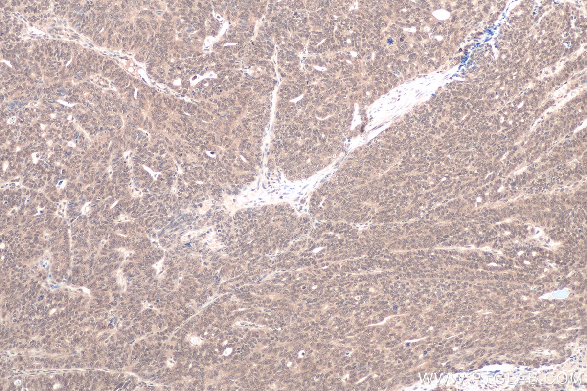 Immunohistochemical analysis of paraffin-embedded human ovary tumor tissue slide using KHC0836 (PPIL1 IHC Kit).