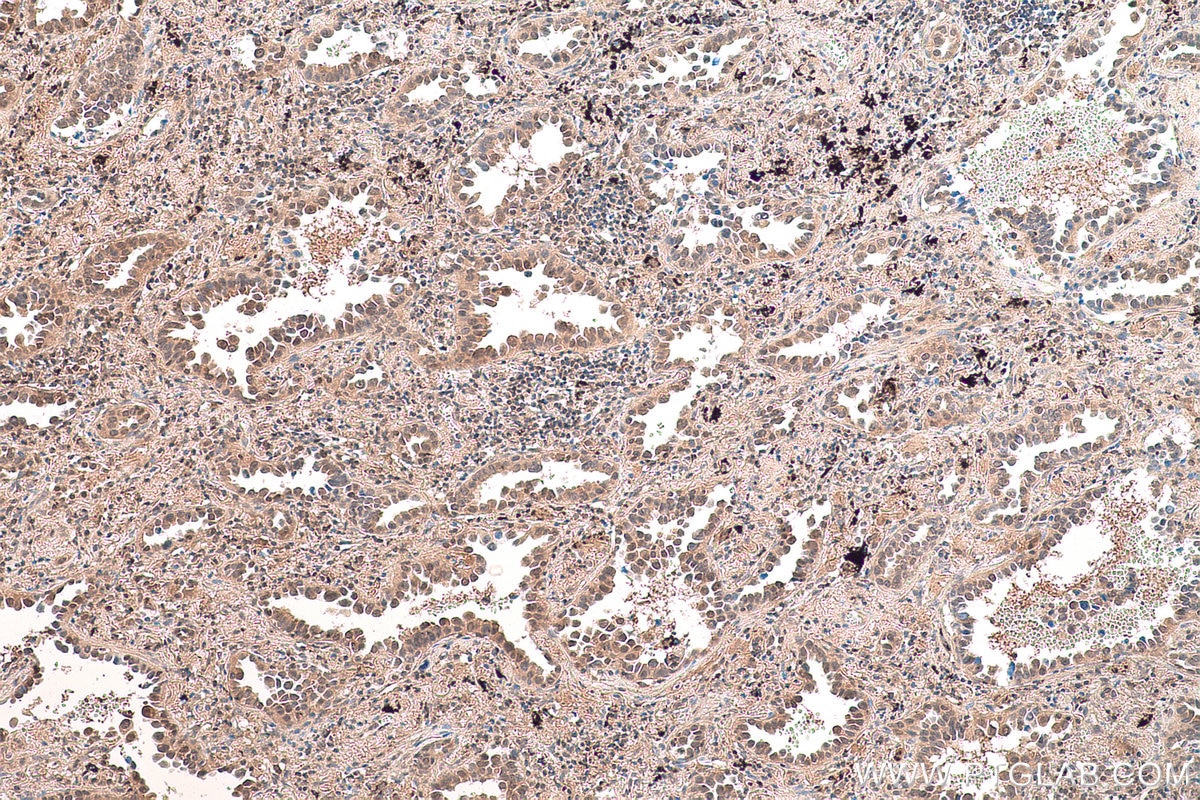 Immunohistochemical analysis of paraffin-embedded human lung cancer tissue slide using KHC0837 (PPIL3 IHC Kit).