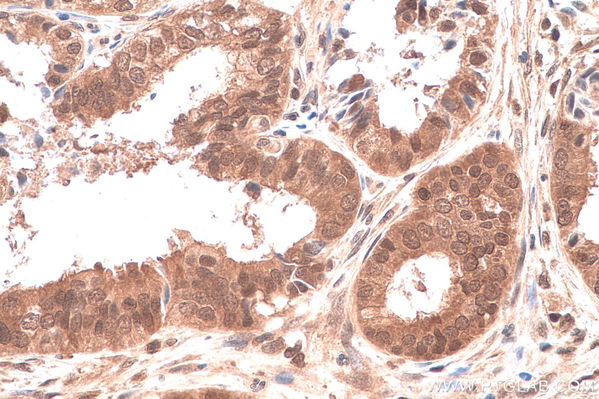Immunohistochemical analysis of paraffin-embedded human ovary tumor tissue slide using KHC0837 (PPIL3 IHC Kit).