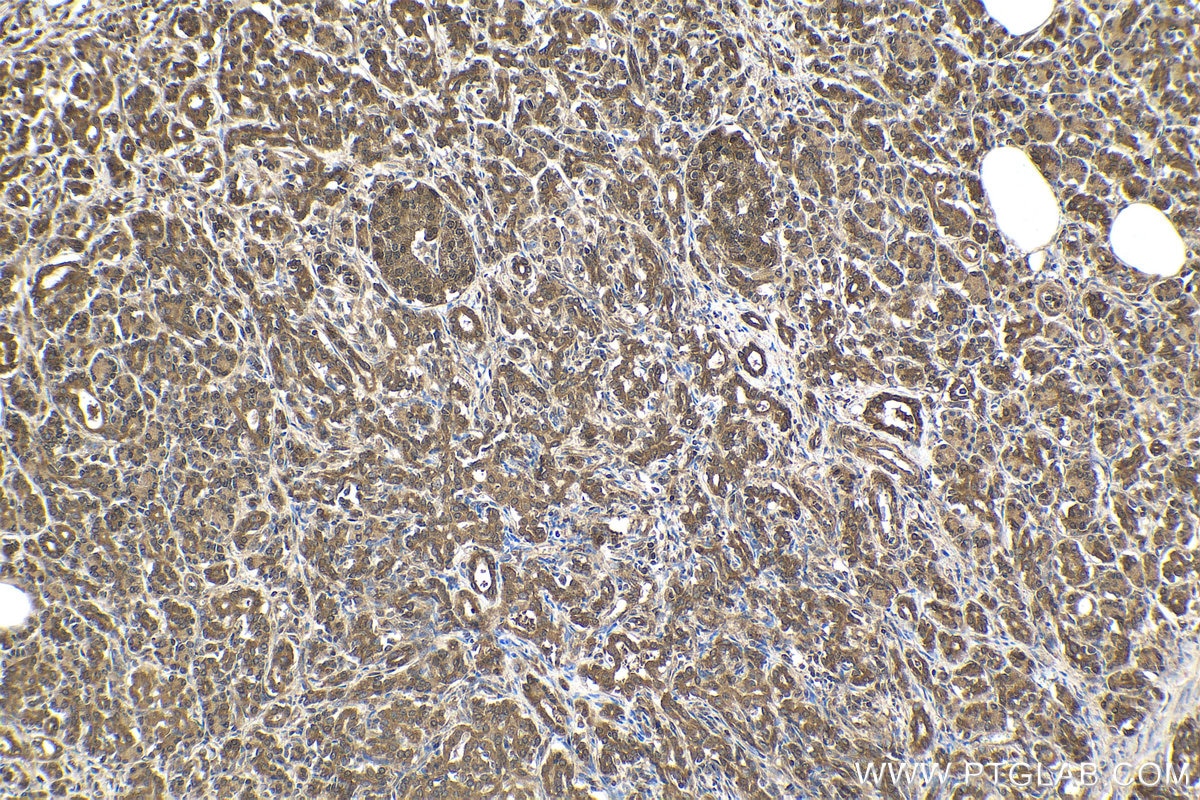 Immunohistochemical analysis of paraffin-embedded human pancreas cancer tissue slide using KHC1586 (PPM1A IHC Kit).