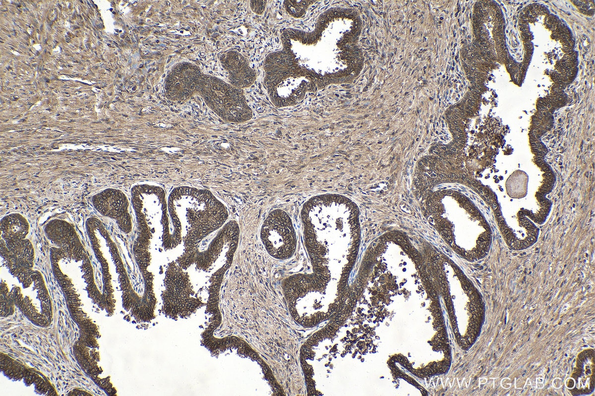 Immunohistochemical analysis of paraffin-embedded human prostate cancer tissue slide using KHC1586 (PPM1A IHC Kit).