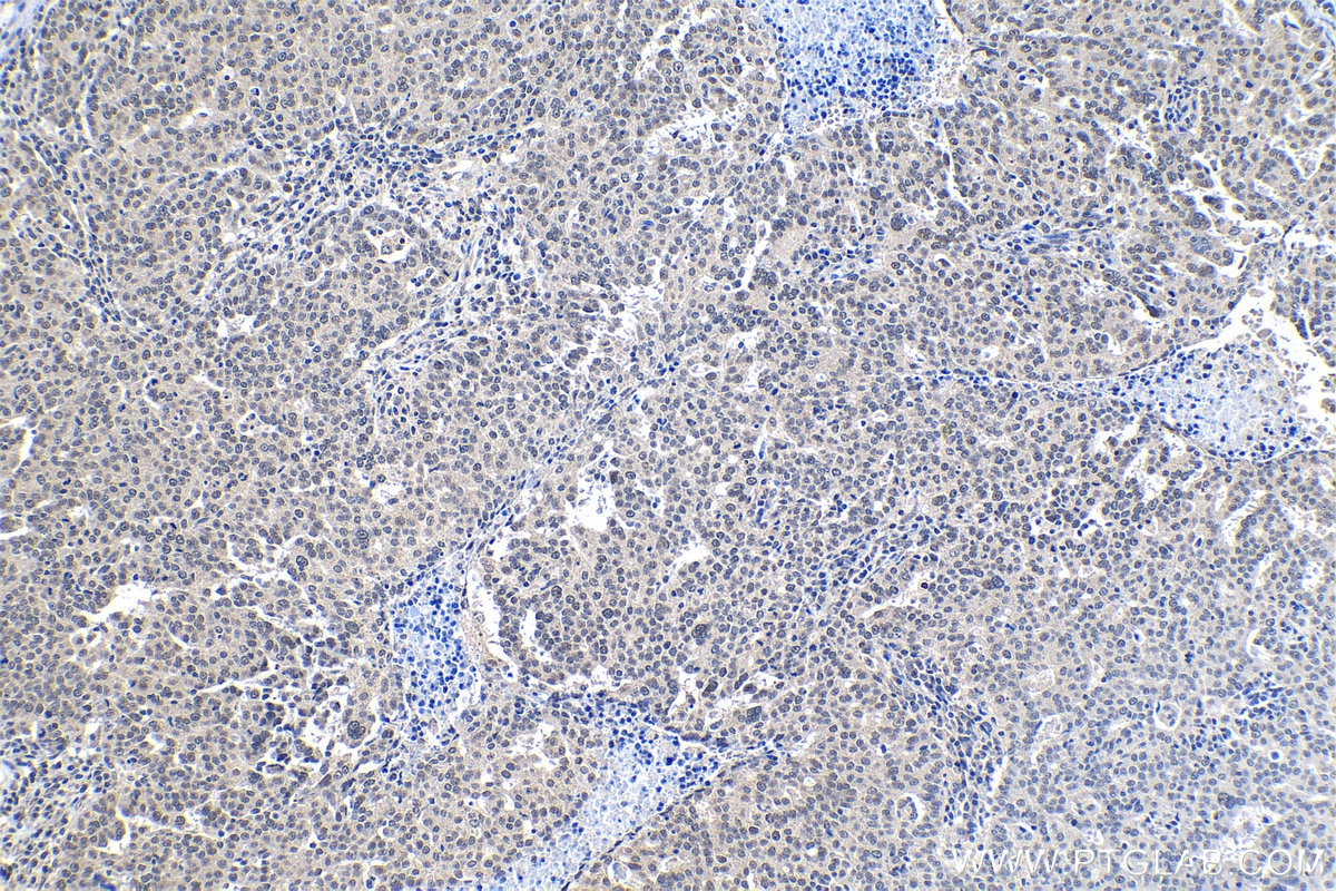 Immunohistochemical analysis of paraffin-embedded human ovary tumor tissue slide using KHC1302 (PPM1G IHC Kit).