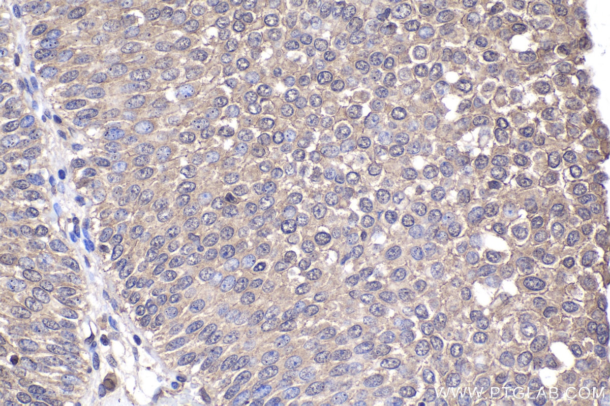 Immunohistochemical analysis of paraffin-embedded human urothelial carcinoma tissue slide using KHC2035 (PPP1CA IHC Kit).