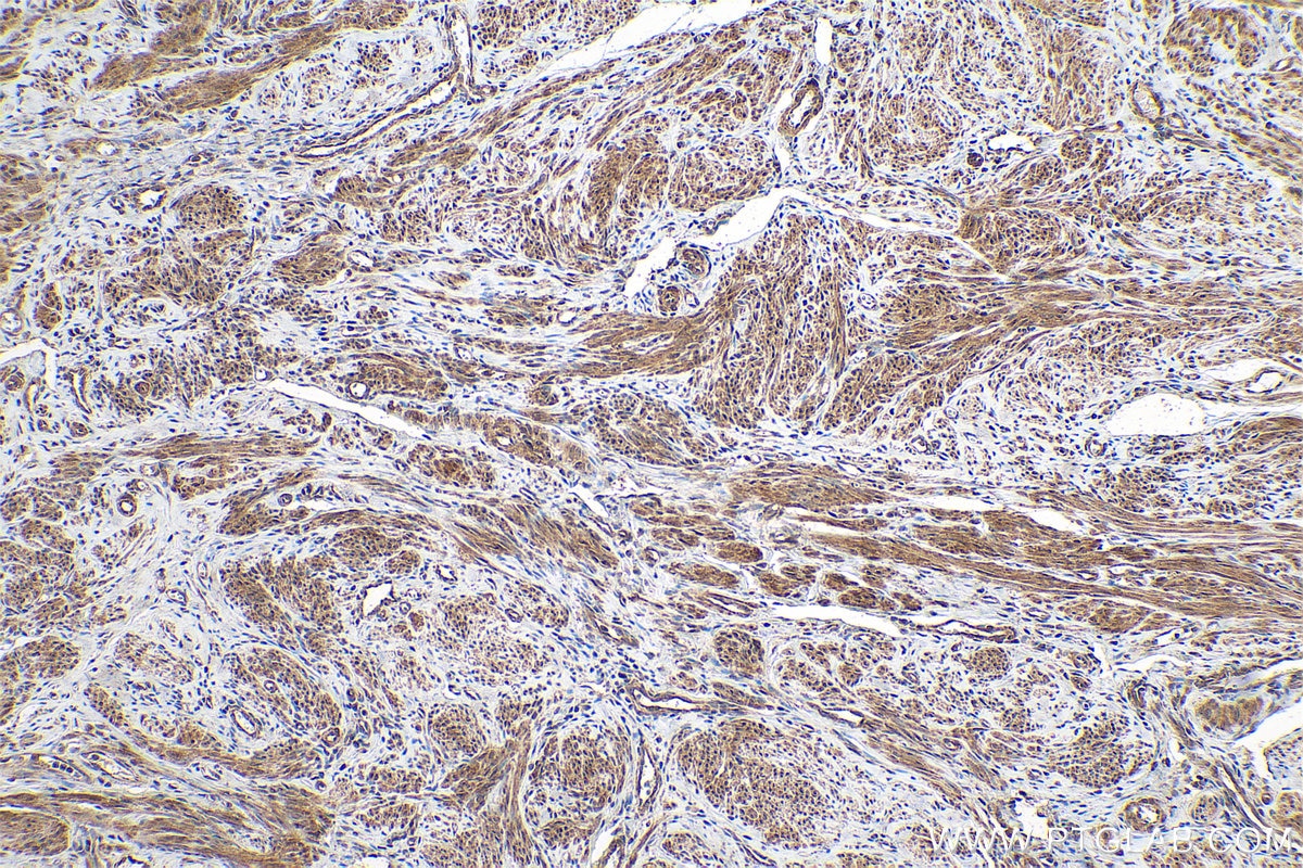 Immunohistochemical analysis of paraffin-embedded human cervical cancer tissue slide using KHC0850 (PPP1CB IHC Kit).