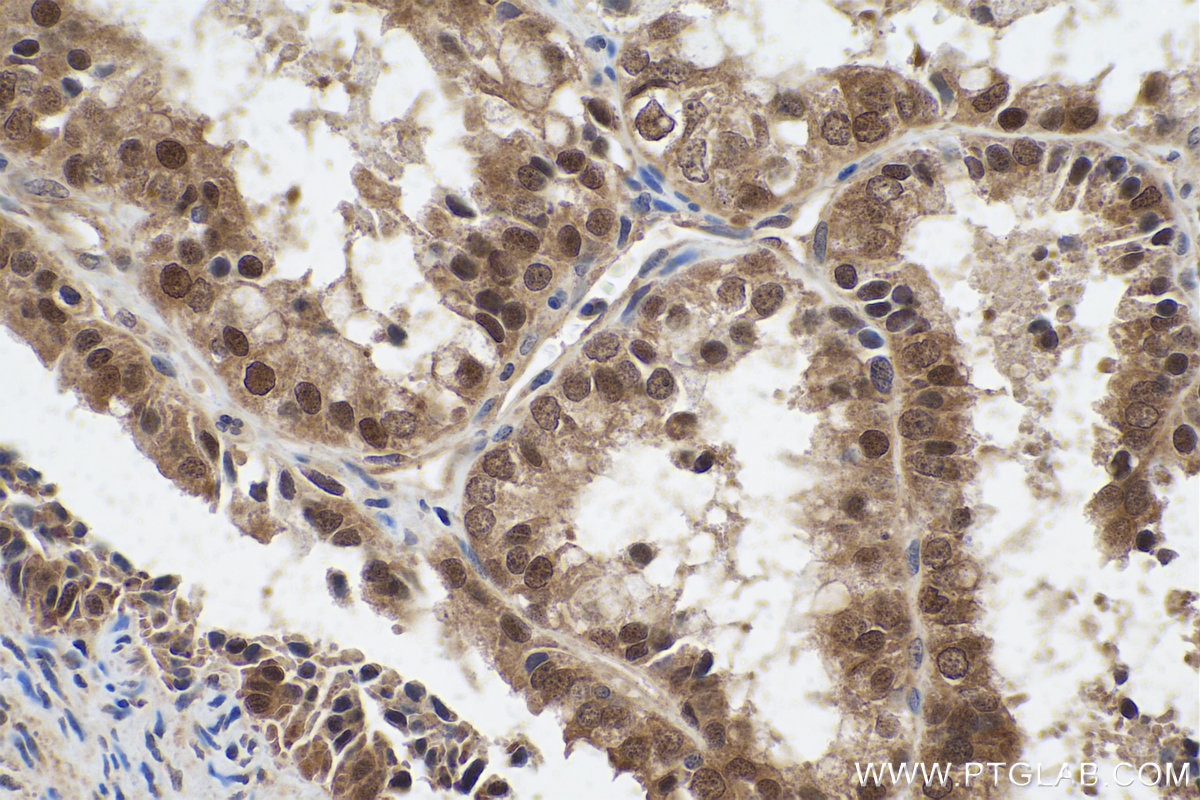 Immunohistochemical analysis of paraffin-embedded human ovary tumor tissue slide using KHC0850 (PPP1CB IHC Kit).