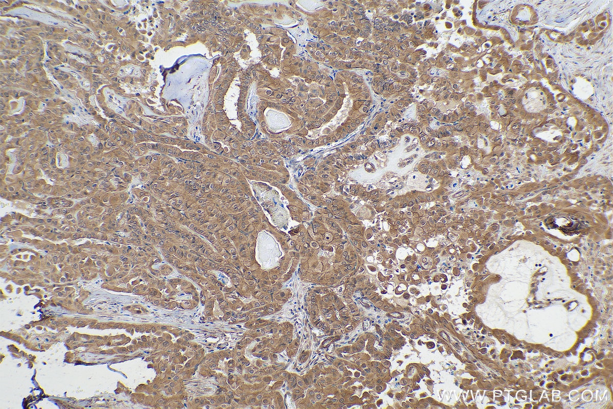 Immunohistochemical analysis of paraffin-embedded human thyroid cancer tissue slide using KHC0850 (PPP1CB IHC Kit).