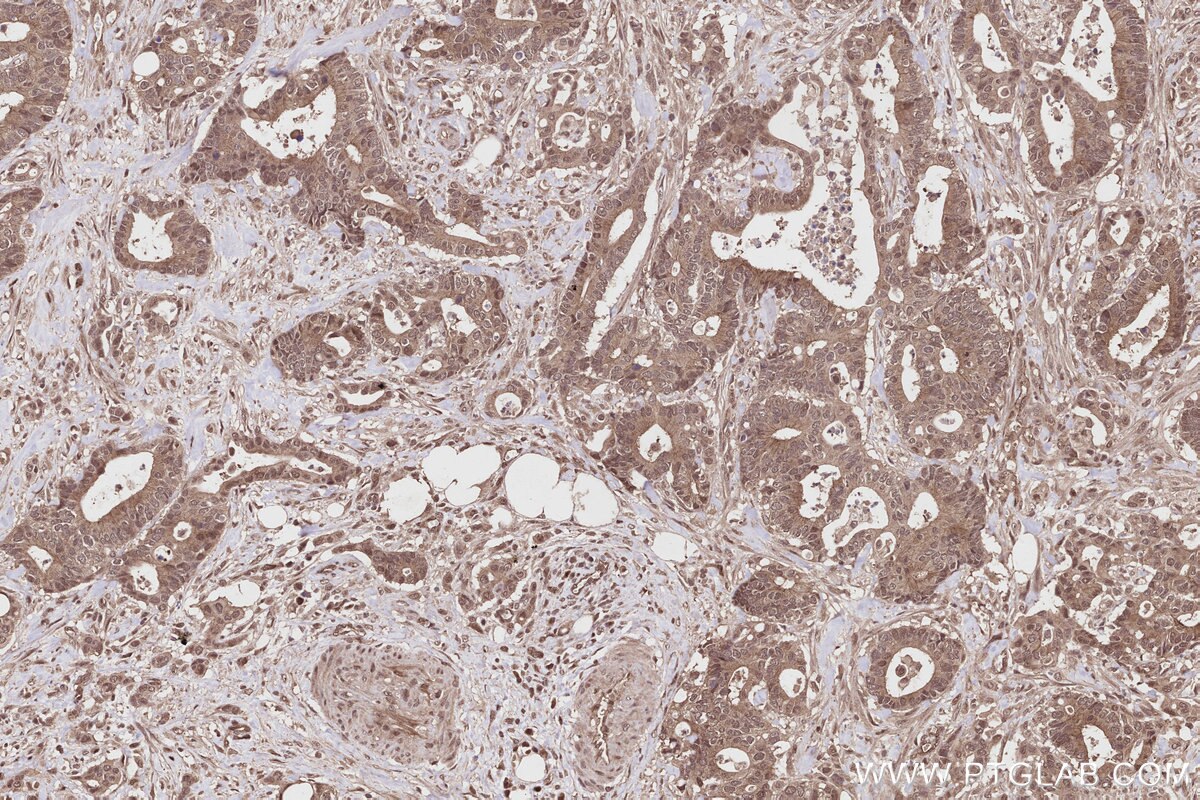 Immunohistochemical analysis of paraffin-embedded human rectal cancer tissue slide using KHC2805 (PPP1R13B IHC Kit).