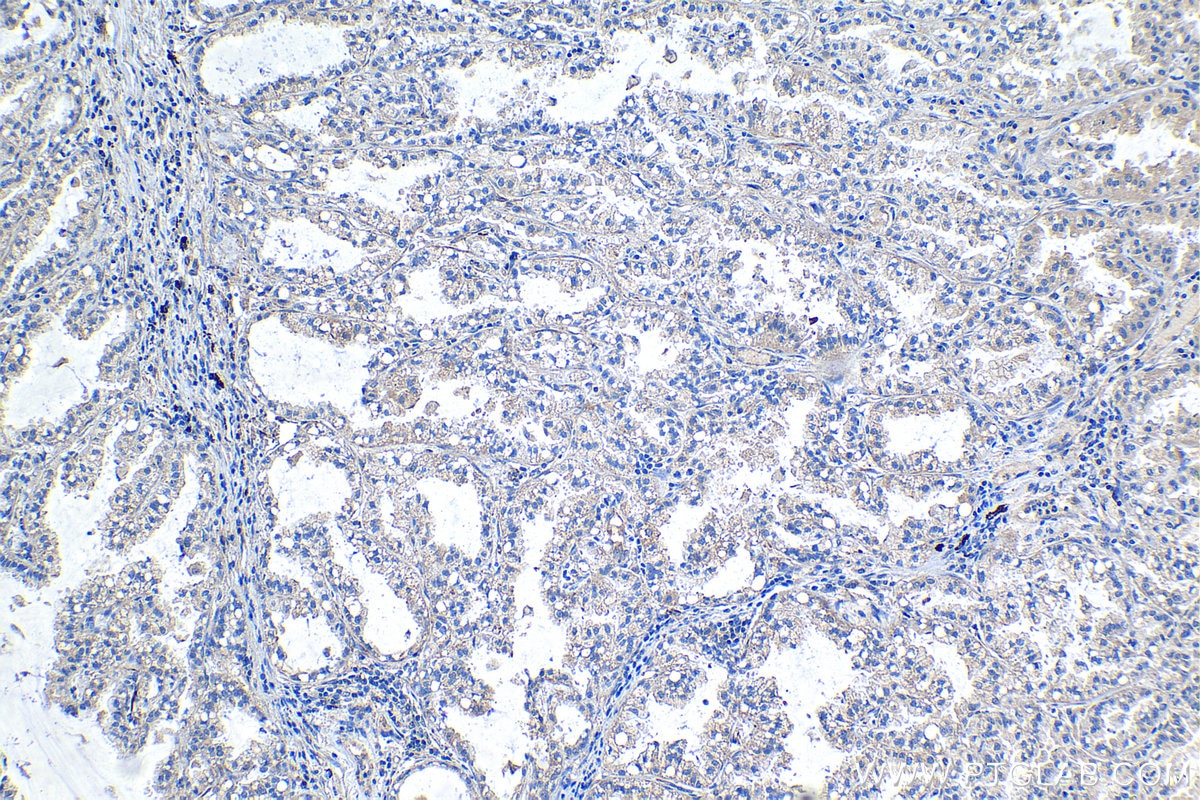 Immunohistochemical analysis of paraffin-embedded human lung cancer tissue slide using KHC1281 (PPP1R13L IHC Kit).