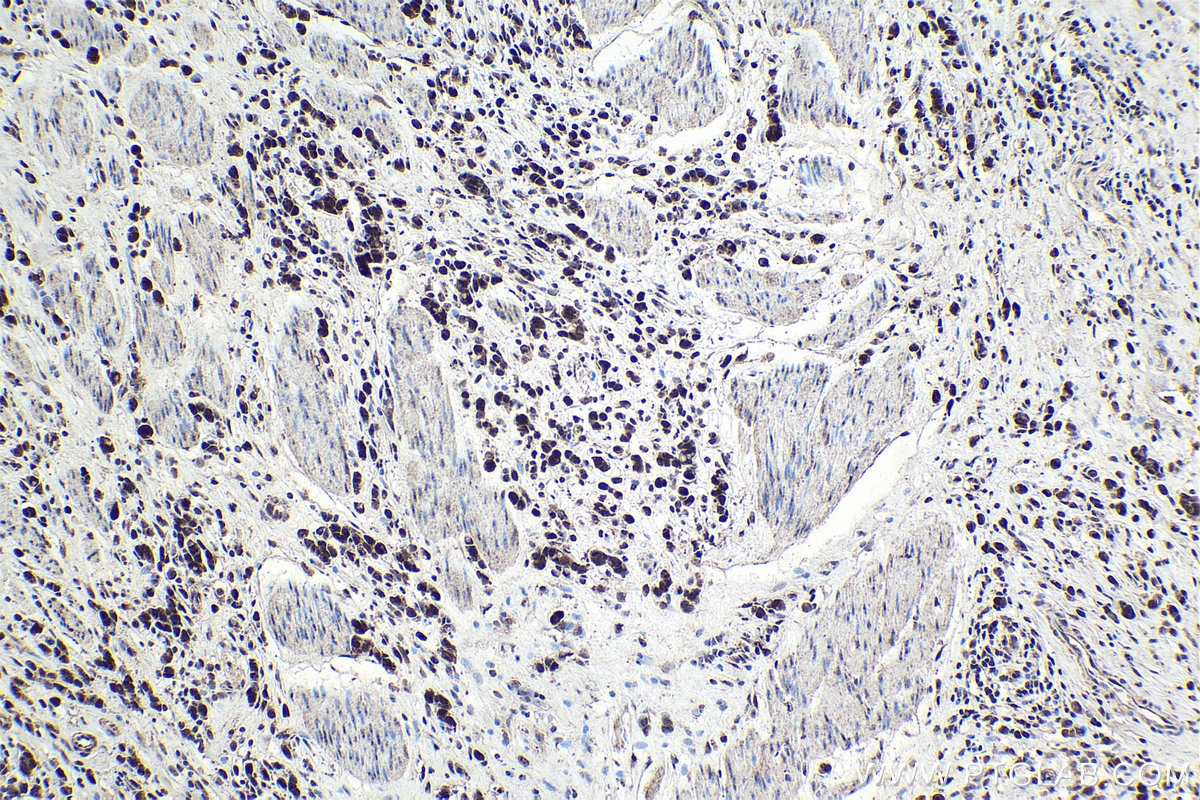 Immunohistochemical analysis of paraffin-embedded human stomach cancer tissue slide using KHC1697 (PPP1R8 IHC Kit).