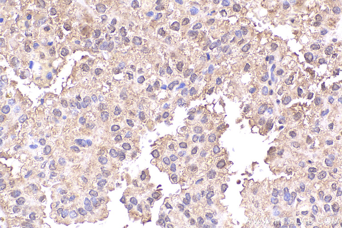 Immunohistochemical analysis of paraffin-embedded human renal cell carcinoma tissue slide using KHC2226 (PPP2R1A IHC Kit).