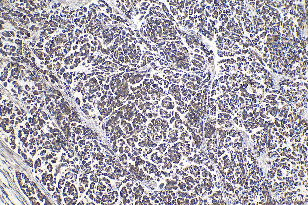 Immunohistochemical analysis of paraffin-embedded human colon cancer tissue slide using KHC1027 (PPP3CA IHC Kit).