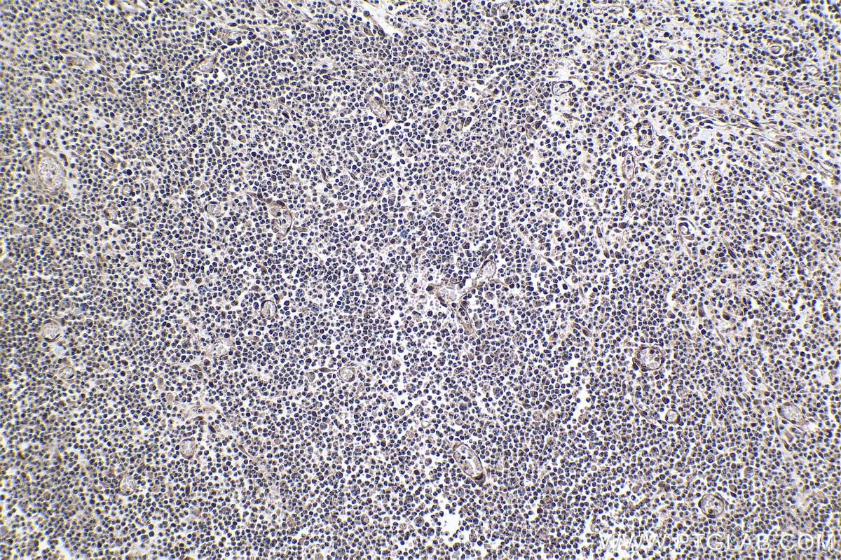 Immunohistochemical analysis of paraffin-embedded human colon cancer tissue slide using KHC1002 (PPP4C IHC Kit).