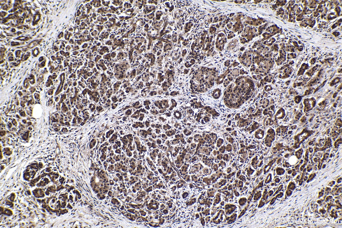 Immunohistochemical analysis of paraffin-embedded human pancreas cancer tissue slide using KHC1002 (PPP4C IHC Kit).