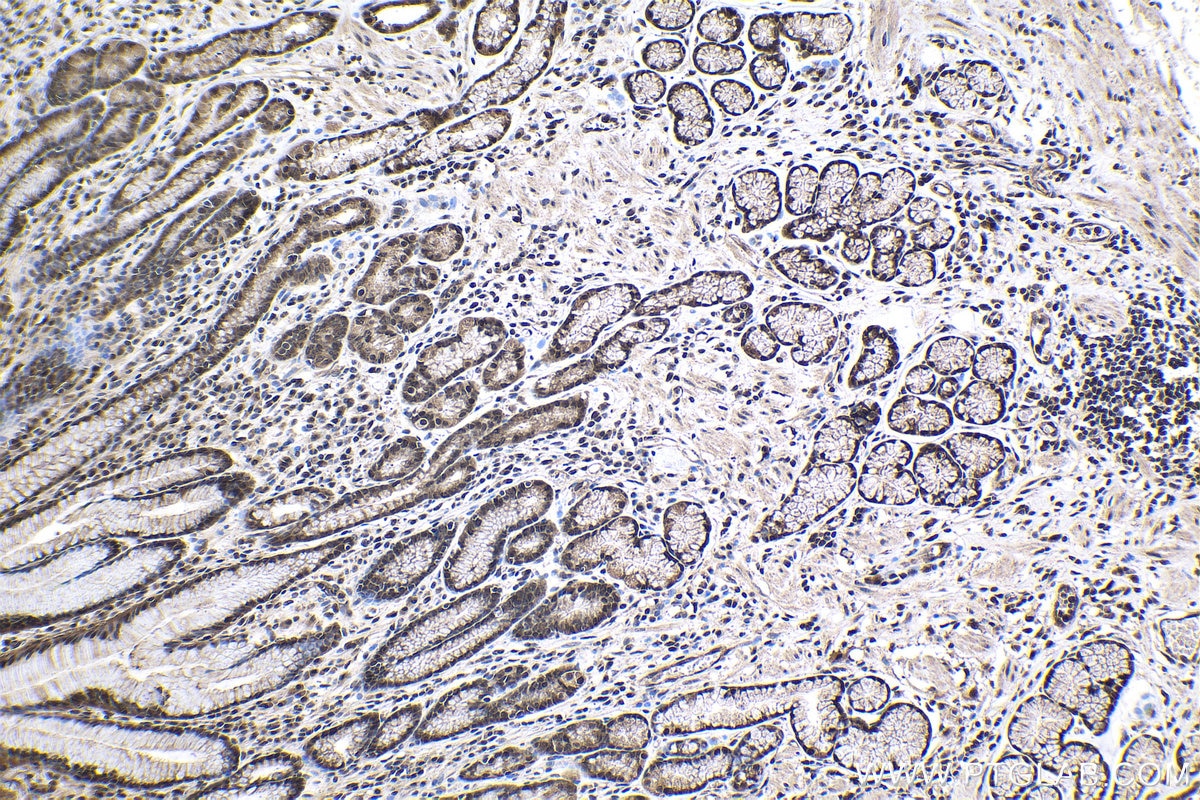 Immunohistochemical analysis of paraffin-embedded human stomach cancer tissue slide using KHC1002 (PPP4C IHC Kit).