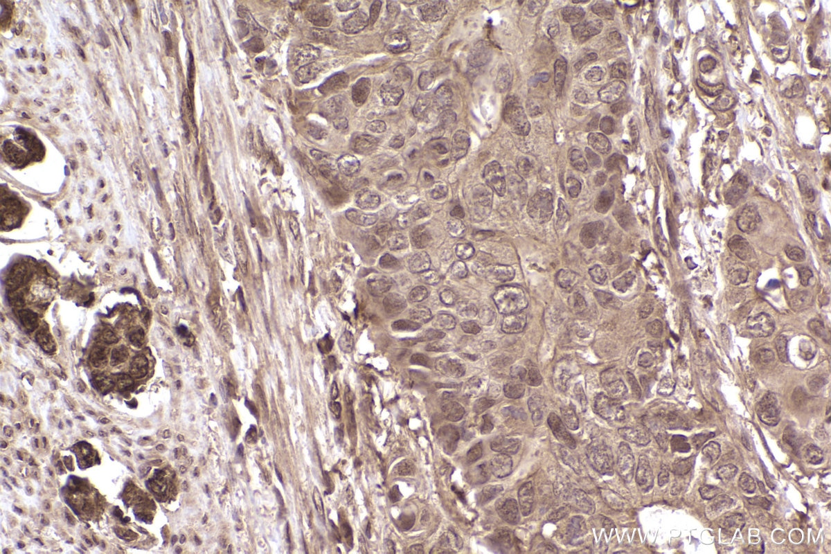 Immunohistochemical analysis of paraffin-embedded human stomach cancer tissue slide using KHC2543 (PPP6R3/SAPS3 IHC Kit).