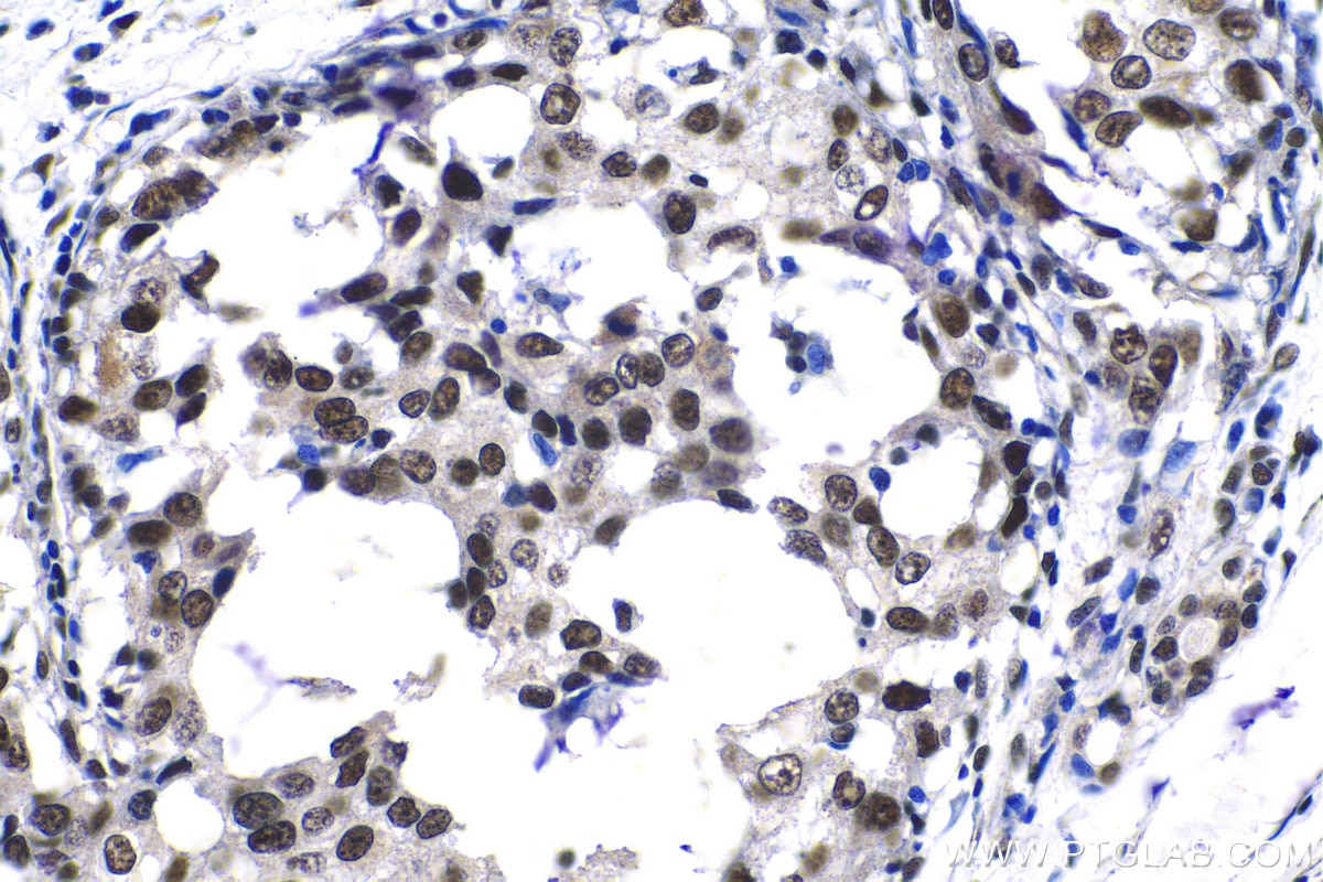 Immunohistochemical analysis of paraffin-embedded human breast cancer tissue slide using KHC1383 (PQBP1 IHC Kit).