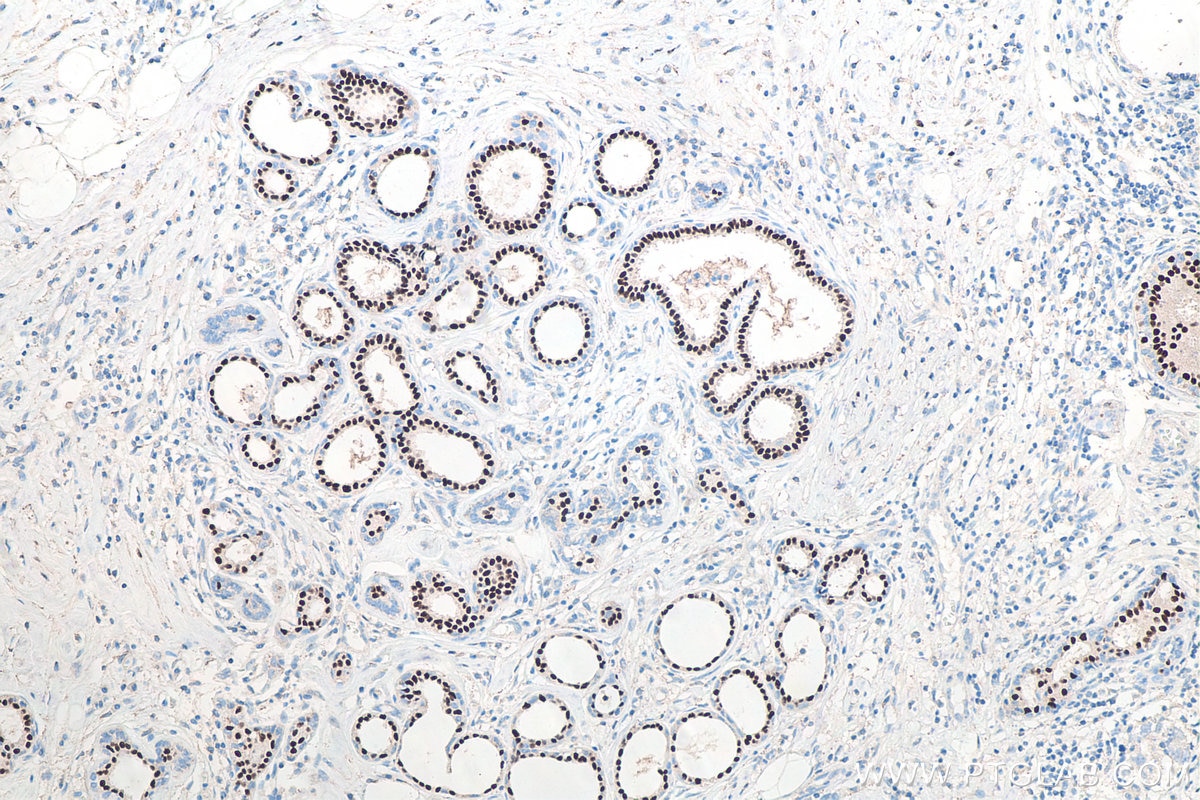 Immunohistochemical analysis of paraffin-embedded human breast cancer tissue slide using KHC0095 (PR IHC Kit).