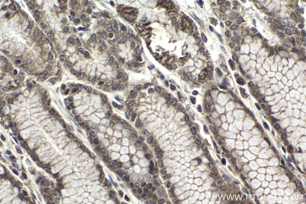 Immunohistochemical analysis of paraffin-embedded human stomach cancer tissue slide using KHC1942 (PRDM16 IHC Kit).