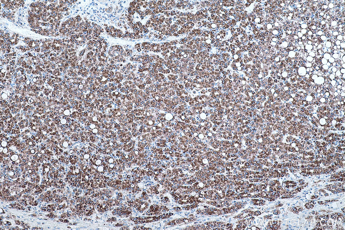 Immunohistochemical analysis of paraffin-embedded human liver cancer tissue slide using KHC0562 (PRDX3 IHC Kit).