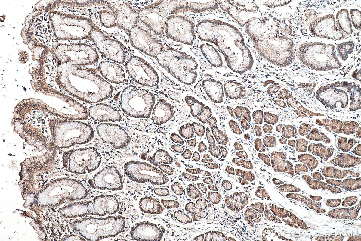 Immunohistochemical analysis of paraffin-embedded human stomach cancer(NAT) tissue slide using KHC0513 (PRDX6 IHC Kit).