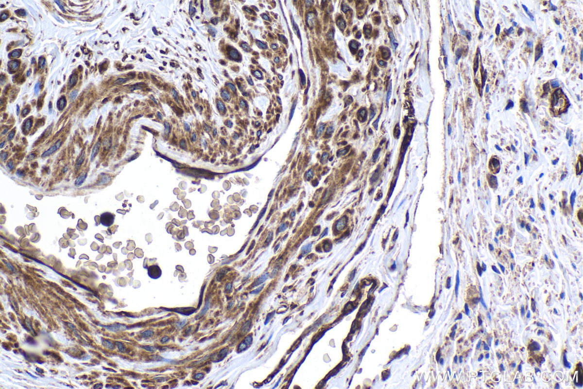 Immunohistochemical analysis of paraffin-embedded human cervical cancer tissue slide using KHC1880 (PRICKLE1 IHC Kit).